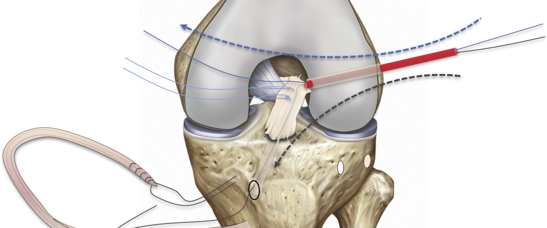 Everything You Need to Know About Tendon Truncations