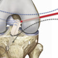Everything You Need to Know About Tendon Truncations