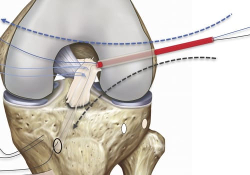 Everything You Need to Know About Tendon Truncations